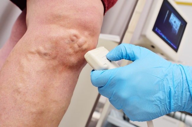 Doctor checking the disease of Atherosclerotic plaque in Phoenix A doctor checking varicose veins on a leg at Arizona Vein & Laser Institute