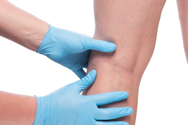 Doctor seeing the blood clot in patient leg in Phoenix Doctor seeing the blood clot in patient leg in Phoenix