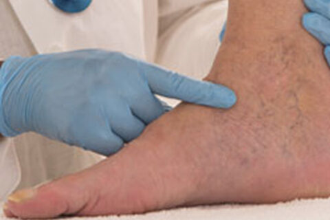 doctor checking foot of man which is swollen