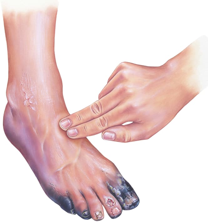 The Graphic image of the man affected with vein at Phoenix, AZ The Graphic image of the man affected with vein at Phoenix, AZ