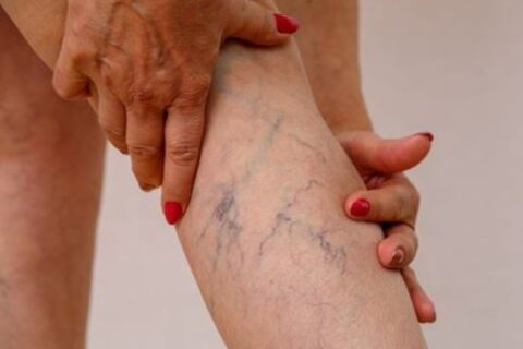 photo of legs vein turned blue and red