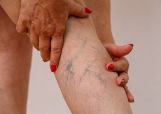 photo of legs vein turned blue and red