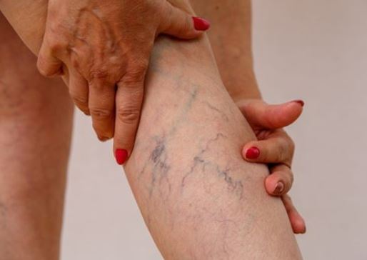 The closed image of Reticular Veins in leg for men at Phoenix, AZ The closed image of Reticular Veins in leg for men at Phoenix, AZ