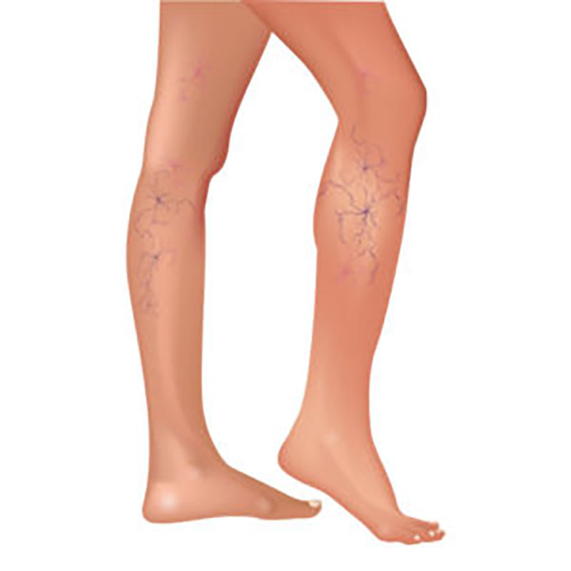 spider veins on legs