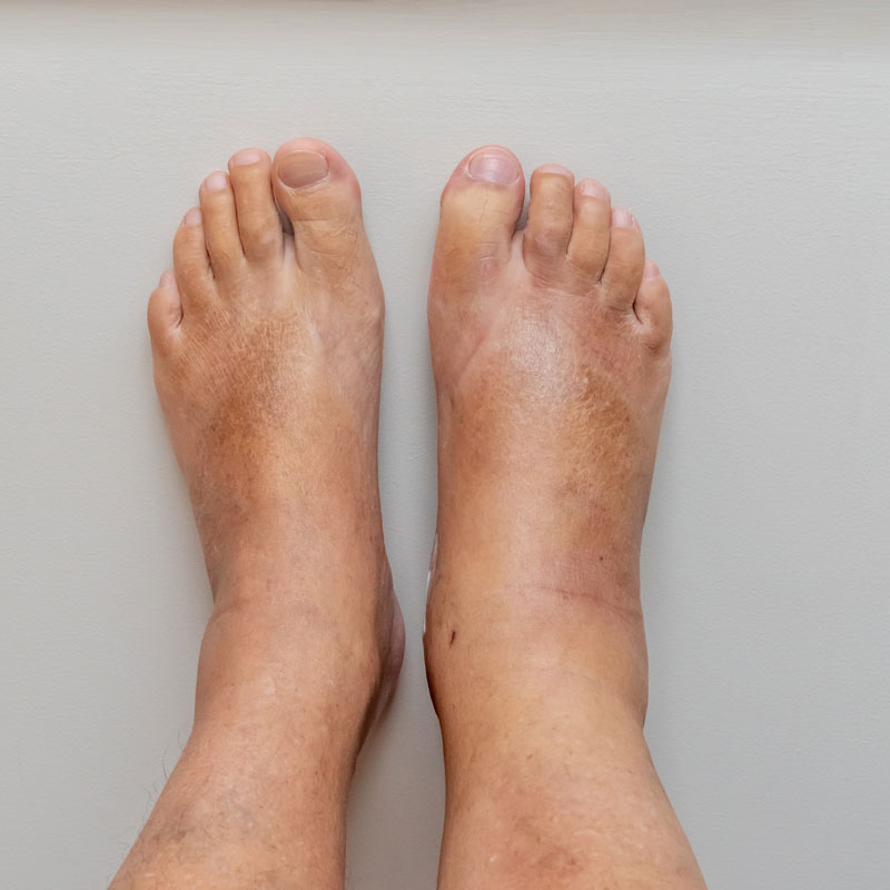 swollen feet