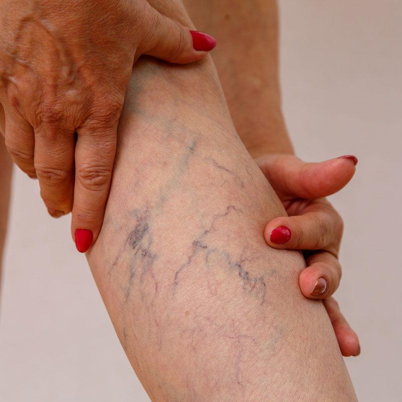 An image of a leg showing varicose veins for treatment at Arizona Vein & Laser Institute in Phoenix