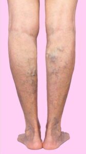 The varicose veins cure treatment for the person in legs