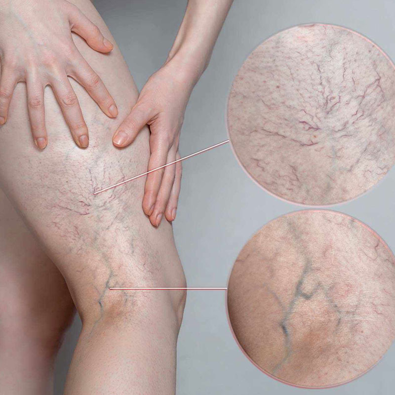 veins on legs