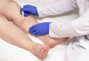  Doctor giving treatment for Varicose veins patient at Phoenix, AZ
