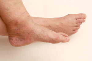 The leg affected by vein disease for men at Phoenix, AZ