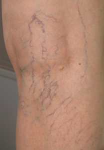 The person suffering for spider veins at Phoenix, AZ