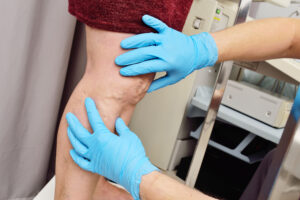 vascular surgeon examines the varicose veins