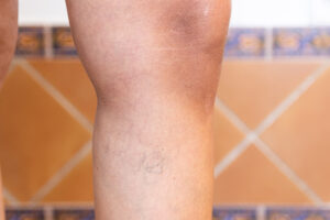 Adult womans leg with varicose veins