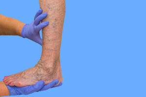 The doctor giving venous insufficiency therapy to patient at Phoenix 