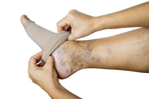The Person puts a compression stocking on her leg for Vein disease