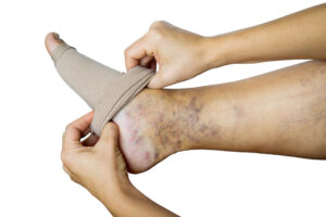 The Person puts a compression stocking on her leg for Vein disease The Person puts a compression stocking on her leg for Vein disease