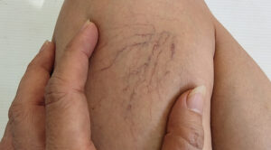 Varicose veins