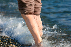 A man with varicose veins walks along the beach in Phoenix, AZ