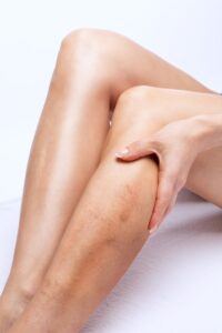 Varicose Vein Treatments