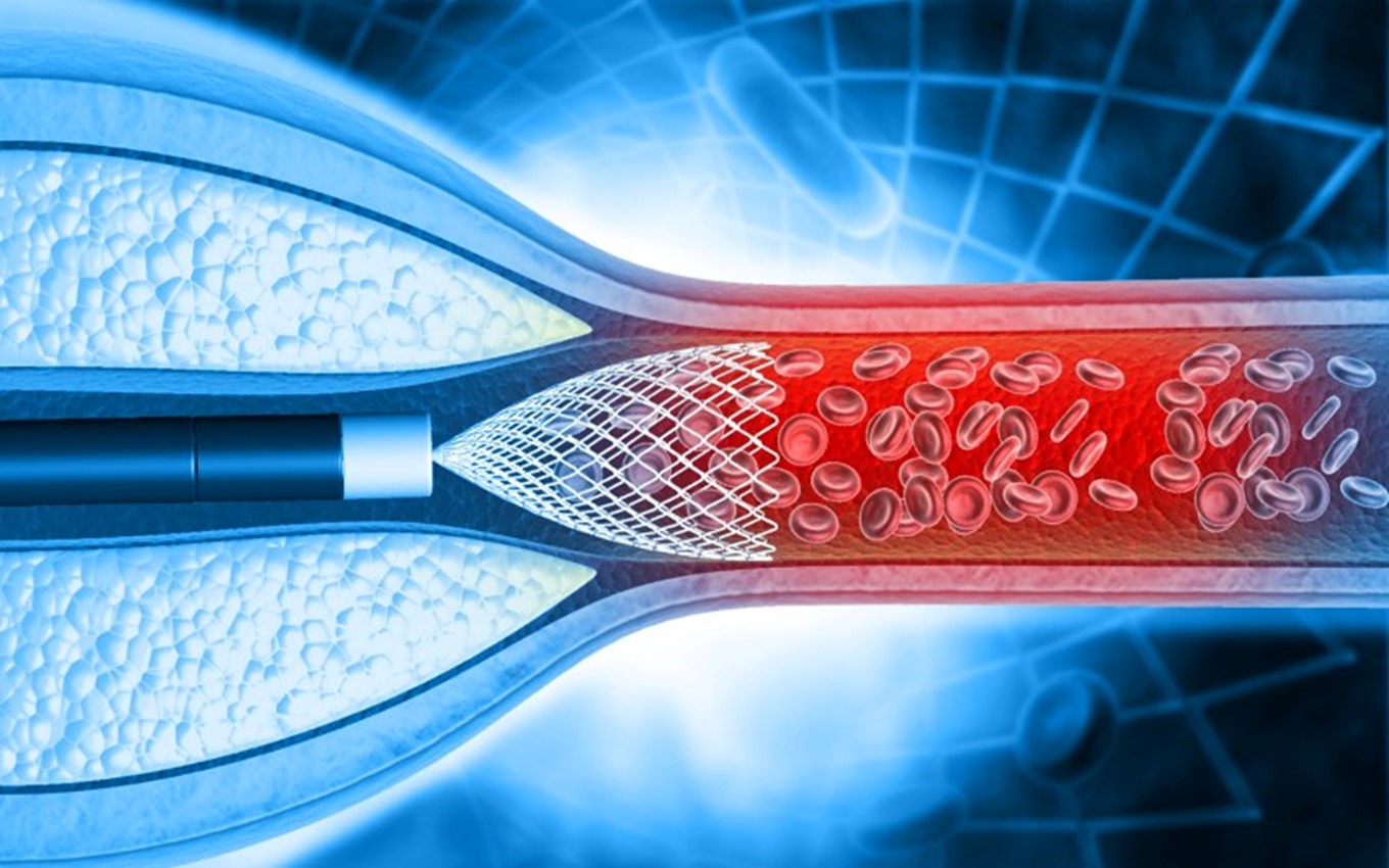 A stent angioplasty illustration by Arizona Vein & Laser Institute