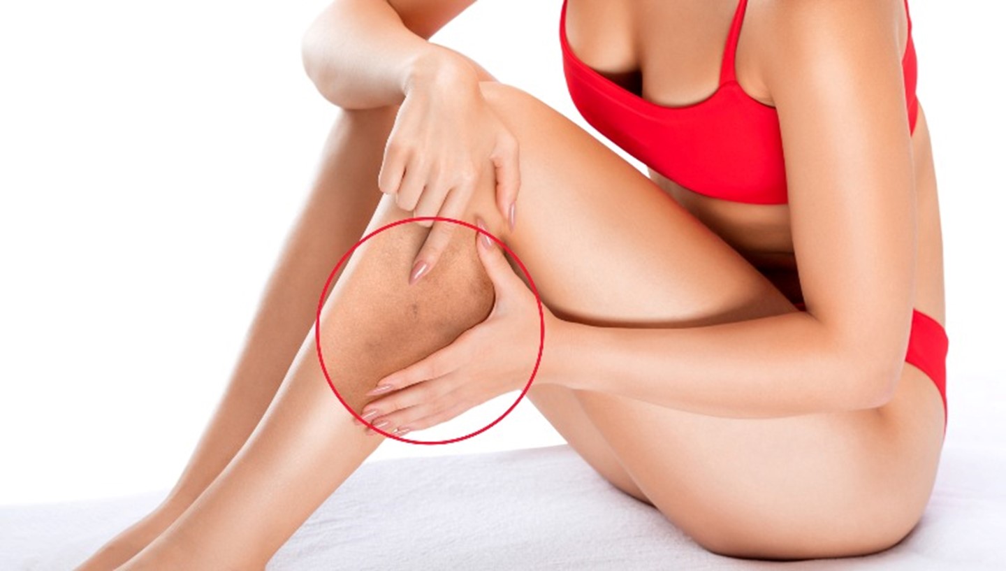 A woman pointing to varicose veins on her leg by Arizona Vein & Laser Institute