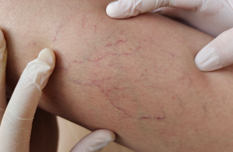 A close up of someone’s leg with varicose veins by Arizona Vein & Laser Institute