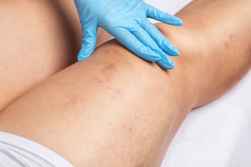 A vascular specialist touching a leg with varicose veins by Arizona Vein & Laser Institute