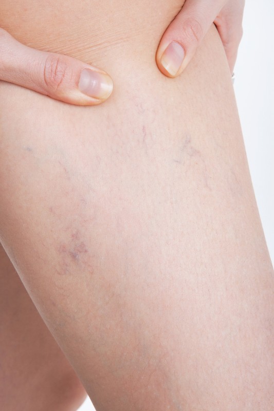 Someone grabbing their leg by spider veins by Arizona Vein & Laser Institute