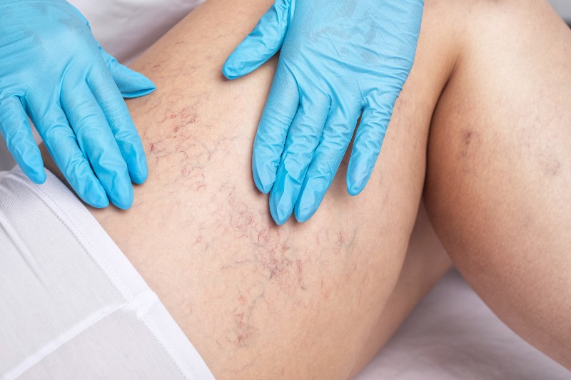 A patient receiving a vein treatment consultation by Arizona Vein & Laser Institute