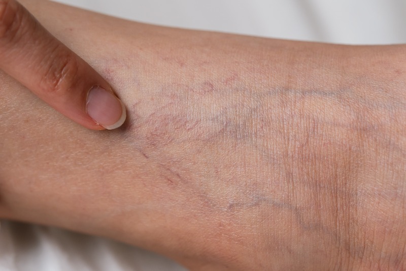 Close-up of spider veins on skin showing fine red and purple vein patterns in Phoenix, AZ, & surrounding areas
