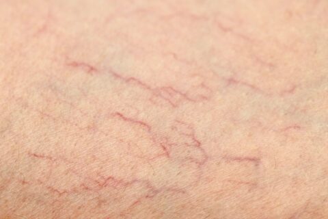 Detailed close-up of spider veins on skin showing fine branching veins in Phoenix, AZ, & surrounding areas