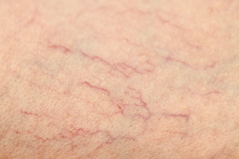 Detailed close-up of spider veins on skin showing fine branching veins in Phoenix, AZ, & surrounding areas