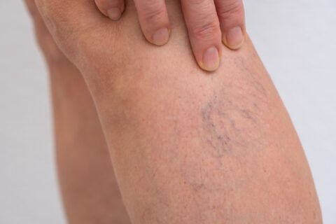 Close-up of varicose veins on calf showing enlarged twisted veins in Phoenix, AZ, & surrounding areas