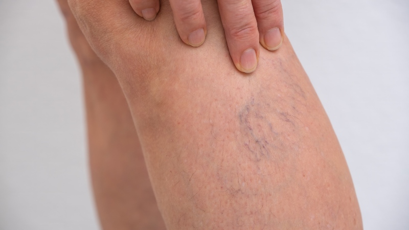 Close-up of varicose veins on calf showing enlarged twisted veins in Phoenix, AZ, & surrounding areas