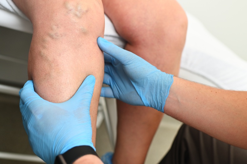 Doctor wearing gloves examining varicose veins on patient’s leg in Phoenix, AZ, & surrounding areas