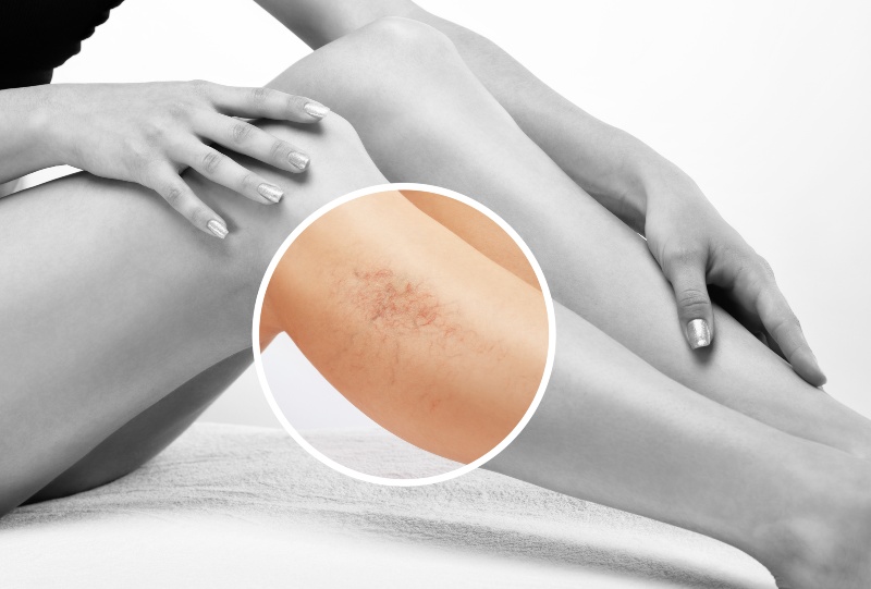 Close-up of spider veins on leg highlighting affected area in Phoenix, AZ, & surrounding areas