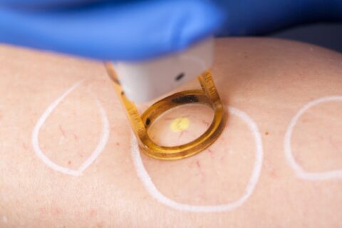 Laser treatment targeting spider veins on skin during procedure in Phoenix, AZ, & surrounding areas
