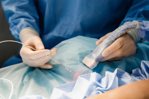 Minimally invasive vein treatment using catheter and laser technology in Phoenix, AZ, & surrounding areas