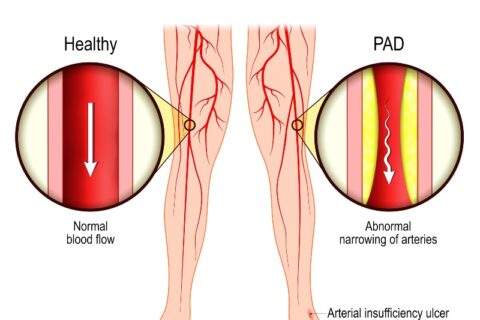 Peripheral artery disease diagram showing reduced blood flow compared to healthy arteries in the legs in Phoenix, AZ, & surrounding areas