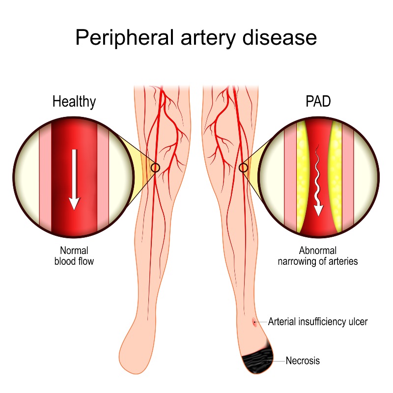 Peripheral artery disease diagram showing reduced blood flow compared to healthy arteries in the legs in Phoenix, AZ, & surrounding areas