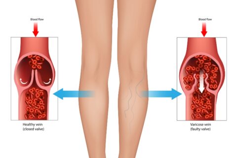 Diagram comparing healthy vein with closed valve and varicose vein with faulty valve in Phoenix, AZ, & surrounding areas