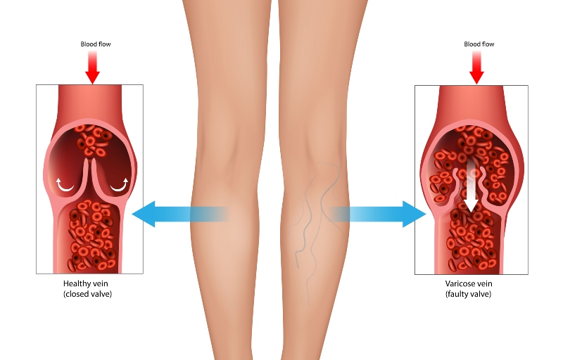 Diagram comparing healthy vein with closed valve and varicose vein with faulty valve in Phoenix, AZ, & surrounding areas